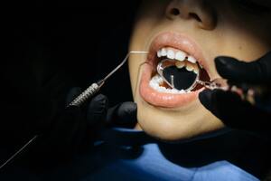 Photo by cottonbro: https://www.pexels.com/photo/close-up-shot-of-a-kid-having-dental-checkup-6502542/